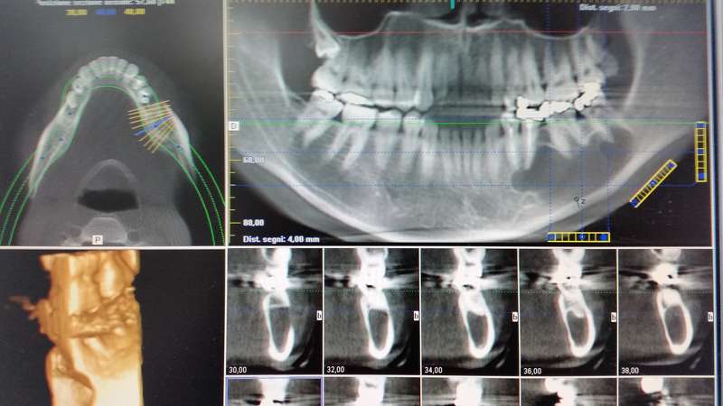 Asportazione neoformazioni odontogene