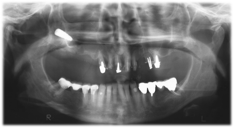 Complicanze della chirurgia implantare