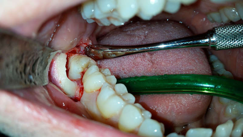 Chirurgia dei terzi molari
