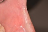 Carcinoma spinocellulare