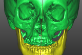 III classe scheletrica - cefalometria 3D attuale