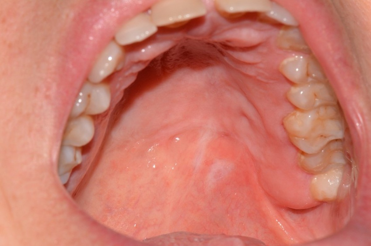 Oncologia Tumori Amerigo Giudice Medico Chirurgo Specialista In Chirurgia Maxillo Facciale