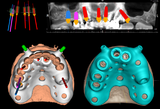 Chirurgia implantare guidata a carico immediato - riabilitazione full arch