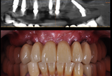 Chirurgia implantare guidata a carico immediato - riabilitazione full arch