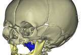 3D Elaboration of skull, jaw and airways in a patient with Pierre Robin Sequence