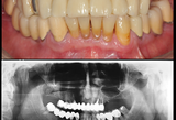 Chirurgia implantare guidata a carico immediato - riabilitazione full arch