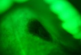Carcinoma a cellule chiare delle ghiandole salivari minori del palato
